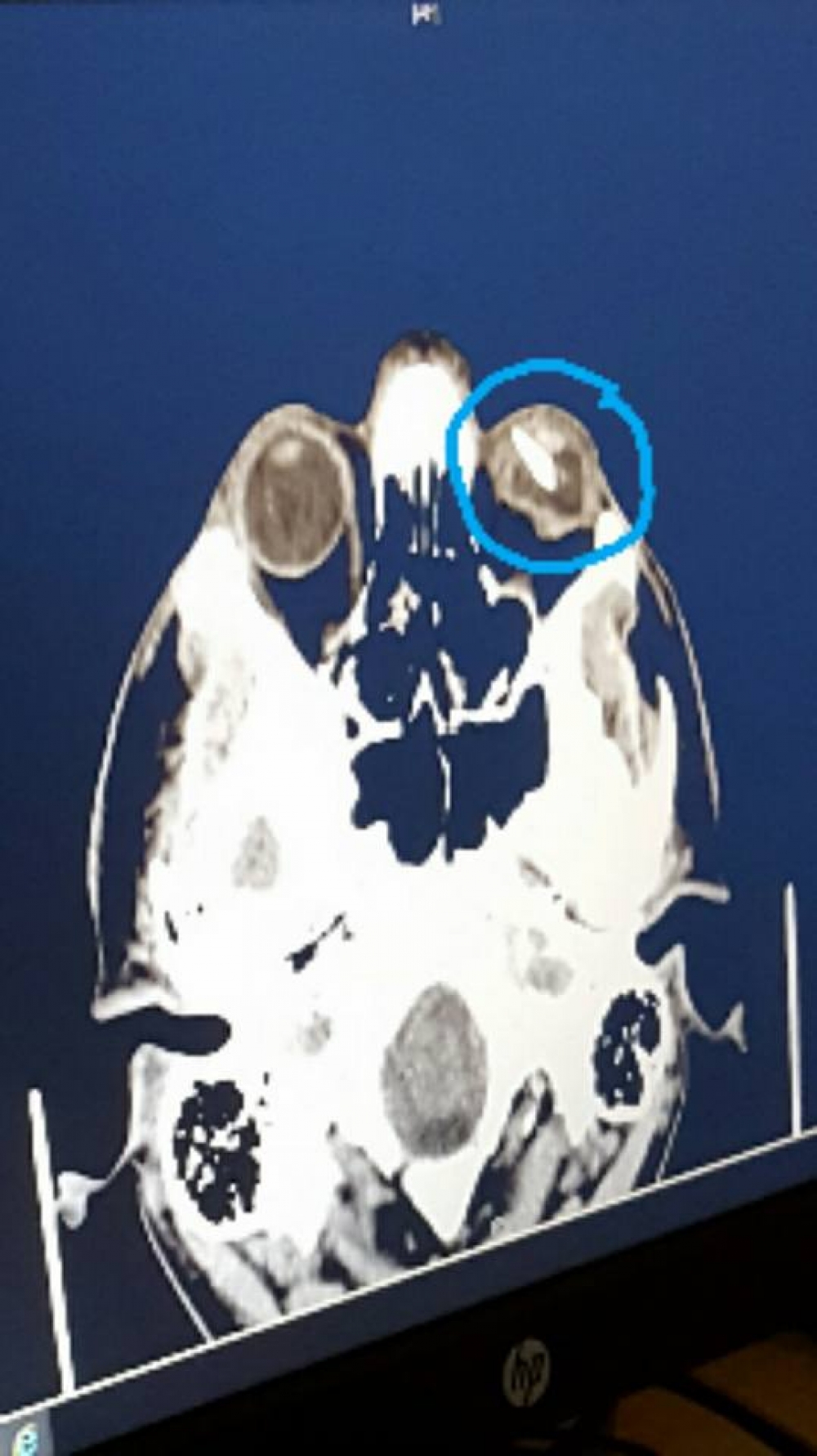 l-Xray ta' għajnejn Ryan Magro fejn hemm ħsara kbira fir-retina fejn tidher il-ħġieġa fir-retina